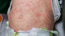  मलङ्गवामा दादुरा फैलिँदै: ७ जना संक्रमित भेटिए, २२ जनालाई घरमै निगरानी