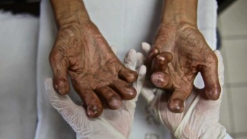 चितवनमा १८ जनामा कुष्ठरोग पुष्टि