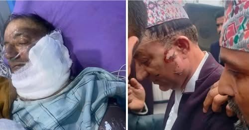 अर्थमन्त्री पौडेललाई ४८ घण्टासम्म आइसीयुमै राखेर उपचार गरिने