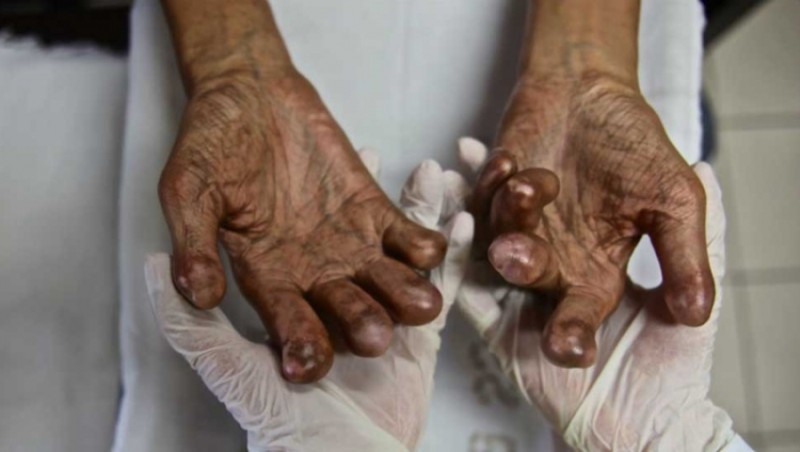 चितवनमा १८ जनामा कुष्ठरोग पुष्टि